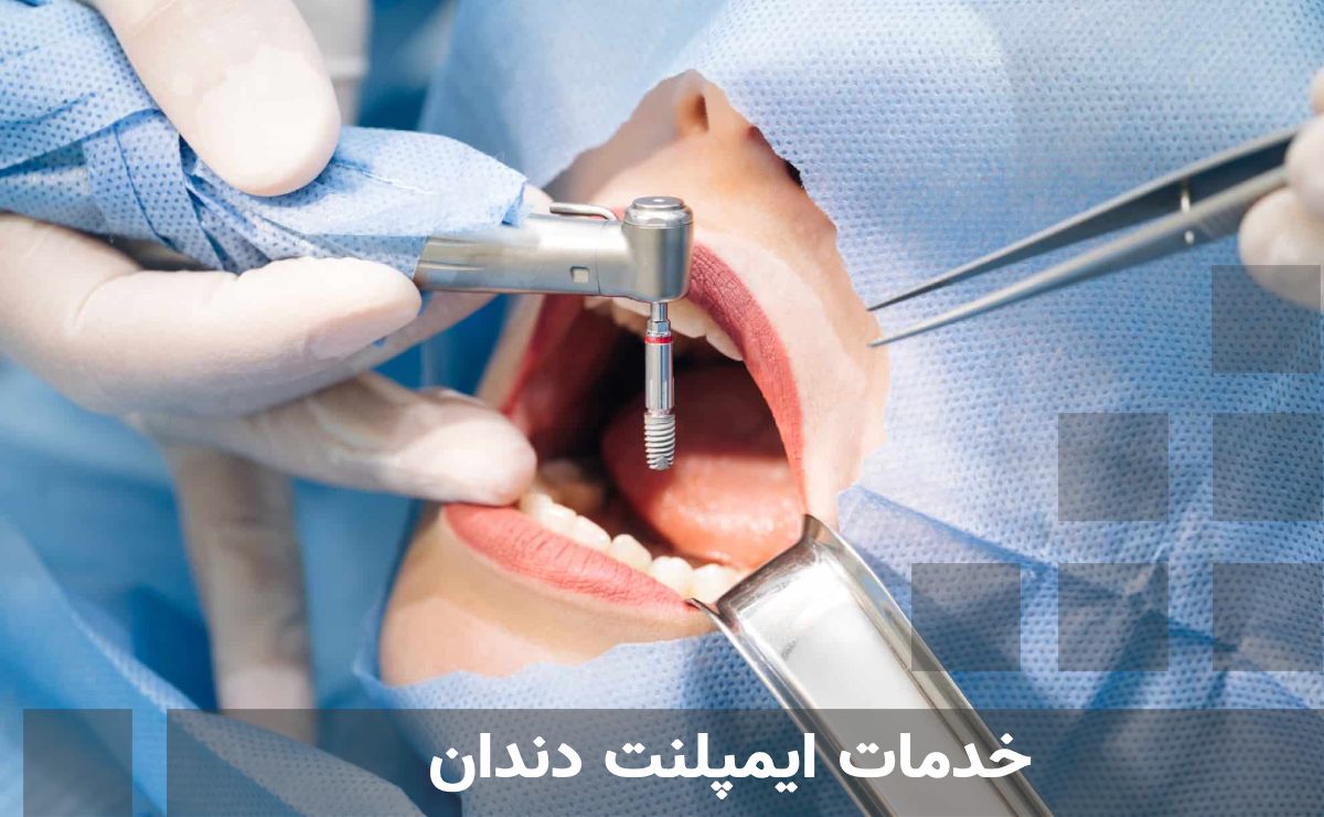 خدمات ایمپلنت دندان