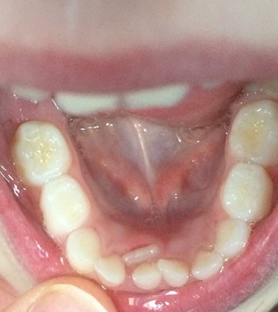 b2ap3_large_large-459417-image1 دندان کوسه ای در کودکان چیست؟ 