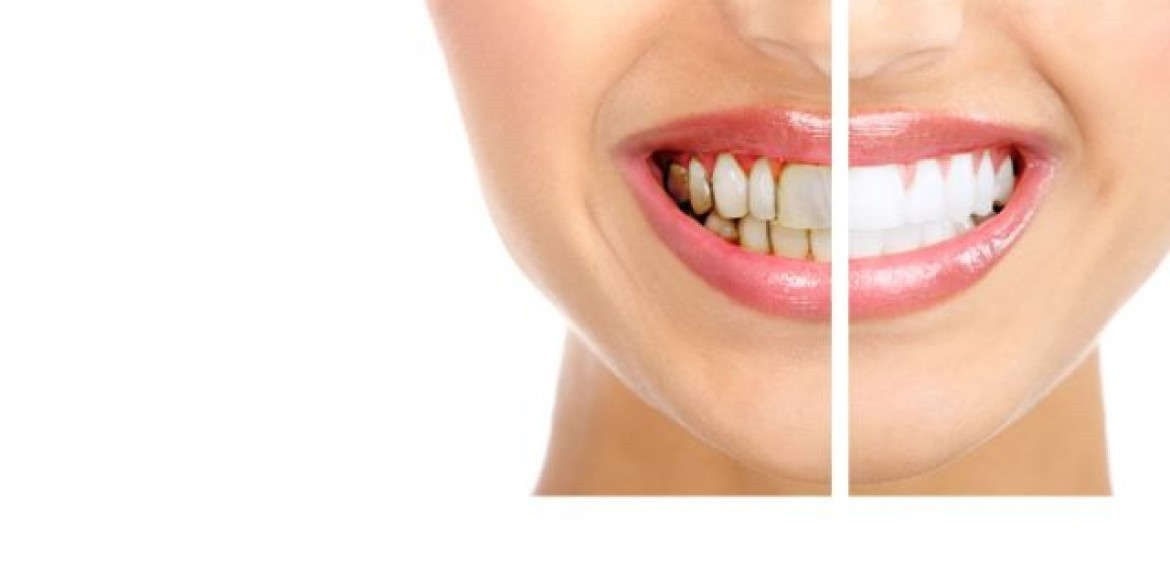 b2ap3_large_2 لمینیت یا ونیر دندان چیست؟ 