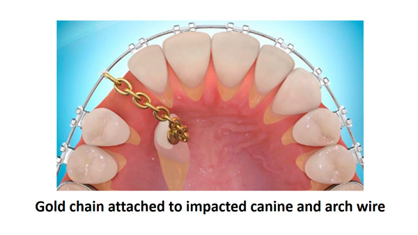 b2ap3_large_canine3 بیرون کشیدن دندان نهفته از  زیر لثه با ارتودنسی