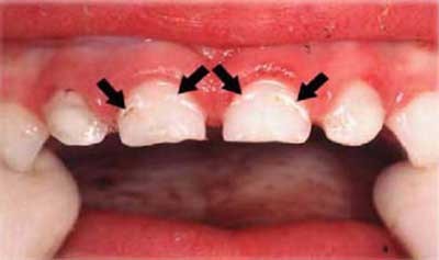 b2ap3_thumbnail_S4CFigure6-1 نقص مینای دندان یا هیپوپلازی مینا