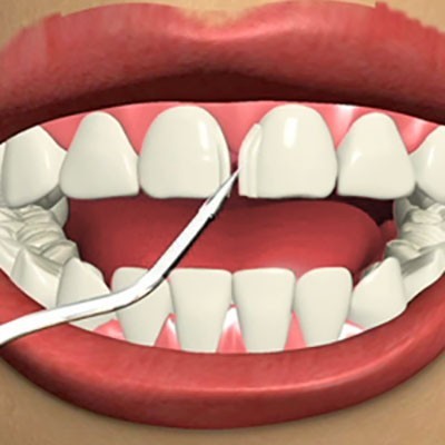 b2ap3_thumbnail_download3 بستن فاصله بین دندانها با روش باندینگ