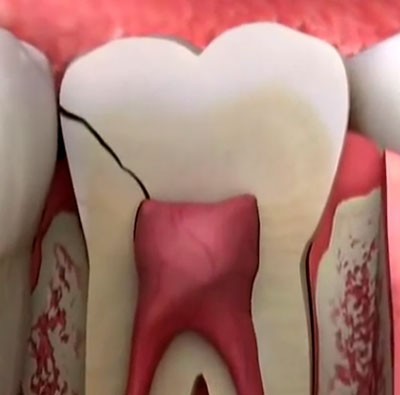 b2ap3_large_why-does-a-cracked-tooth-hurt-2 سندرم ترک خوردن دندان