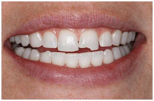 chipped-tooth-smil_20180610-071100_1 روشهای درمان ترک خوردگی و شکستگی دندان